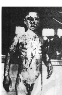 Nagasaki Boy Victim