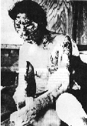 Hiroshima Woman Victim